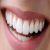 کامپوزیت دندان یا لمینت با روش اقساطی